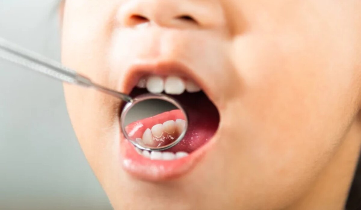 Teeth Cavity: दांतों के कैविटी को जड़ से खत्म करना हो, तो बस नारियल तेल के साथ मिलाकर लगाएं, आपको कभी भी कैविटी नहीं होगी